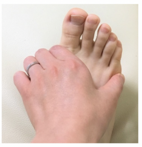 足の指の付け根 腫れ
