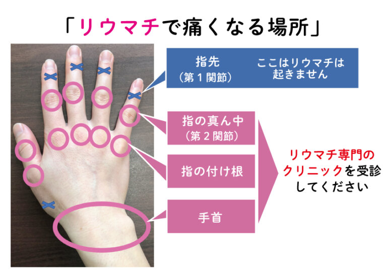 ガングリオン嚢胞